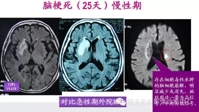 脑梗塞分期迎来革新，新标准助力康复之路更加光明